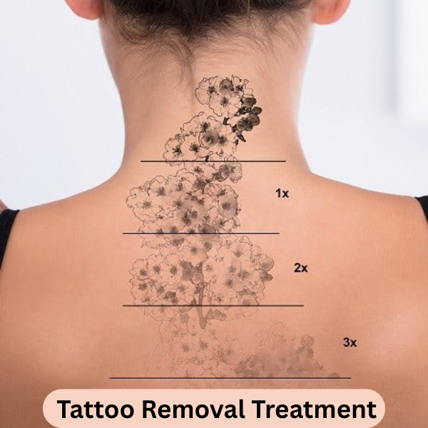 Tattoo Removal Treatment